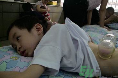 小孩可以拔罐嗎？寶寶能拔火罐嗎？