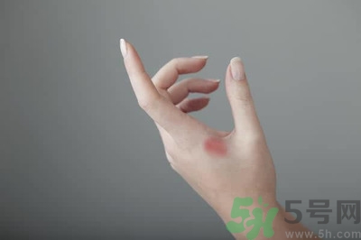 手被燙紅了怎么辦？手被燙了怎么止痛？