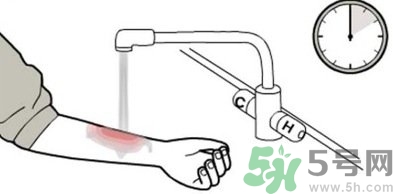 手被燙紅了怎么辦？手被燙了怎么止痛？