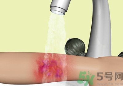 手被燙紅了怎么辦？手被燙了怎么止痛？