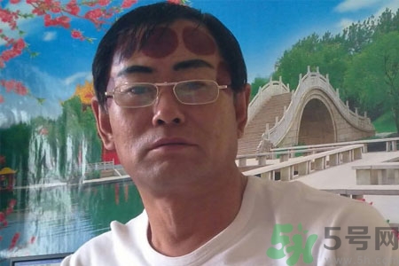 頭痛可以在額頭上拔火罐嗎？額頭上拔火罐有什么好處？