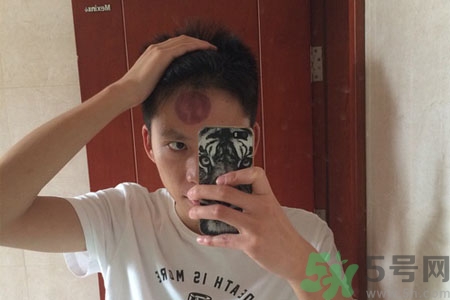 頭痛可以在額頭上拔火罐嗎？額頭上拔火罐有什么好處？