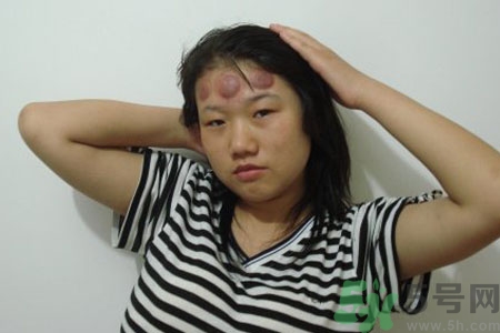 頭痛可以在額頭上拔火罐嗎？額頭上拔火罐有什么好處？