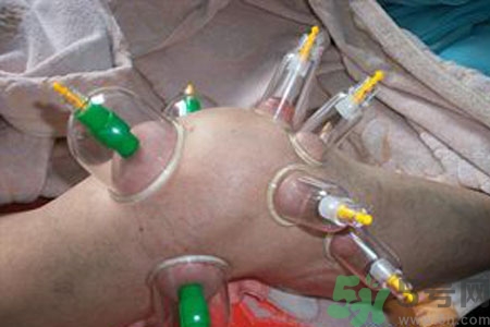 膝蓋能拔罐嗎？膝蓋疼可以拔罐嗎？