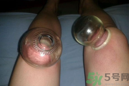 膝蓋能拔罐嗎？膝蓋疼可以拔罐嗎？