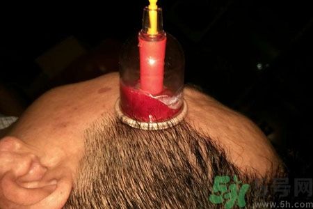 太陽穴可以拔火罐嗎？偏頭疼可以在太陽穴拔火罐嗎？