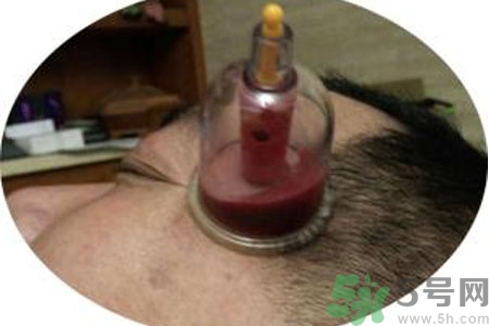 太陽穴可以拔火罐嗎？偏頭疼可以在太陽穴拔火罐嗎？