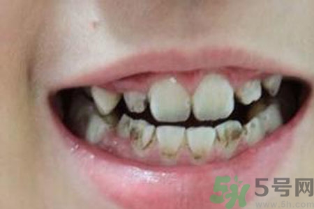 小孩牙齒發(fā)黑怎么回事？小孩牙齒發(fā)黑怎么辦？