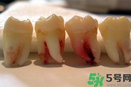 智齒長歪了一定要拔嗎？智齒長歪了必須拔嗎？