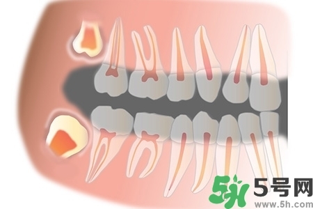 智齒長歪了一定要拔嗎？智齒長歪了必須拔嗎？