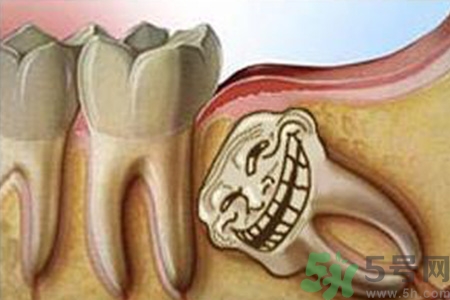 智齒長歪了一定要拔嗎？智齒長歪了必須拔嗎？