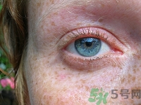 孕婦長斑怎么辦?孕婦長斑怎么治療最有效 孕婦長斑怎么辦?孕婦長斑怎么治療最有效