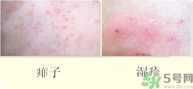 濕疹和痱子一樣嗎？濕疹和痱子有甚么區(qū)別？