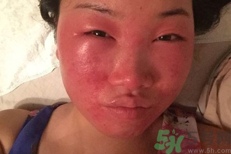 臉過敏發(fā)紅癢怎么辦？臉過敏發(fā)紅癢擦什么藥好？