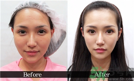 削骨瘦臉手術(shù)疼嗎?削骨瘦臉手術(shù)危險(xiǎn)嗎? 削骨瘦臉手術(shù)疼嗎?削骨瘦臉手術(shù)危險(xiǎn)嗎?