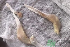 削骨瘦臉手術(shù)疼嗎?削骨瘦臉手術(shù)危險(xiǎn)嗎? 削骨瘦臉手術(shù)疼嗎?削骨瘦臉手術(shù)危險(xiǎn)嗎?