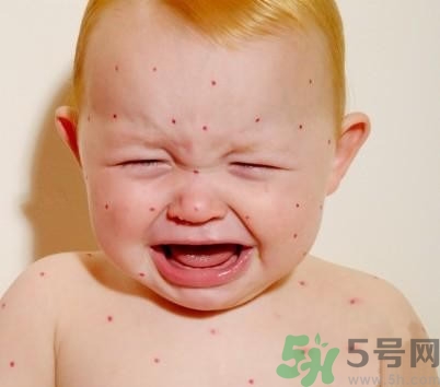 新生兒濕疹怎么引起的？新生兒濕疹如何處理？