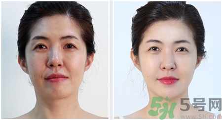 超聲刀適合多大年齡做?超聲刀適合多大歲數(shù)? 超聲刀適合多大年齡做?超聲刀適合多大歲數(shù)?