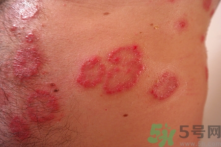 蕁麻疹能否根治?蕁麻疹該怎么治療 蕁麻疹能否根治?蕁麻疹該怎么治療