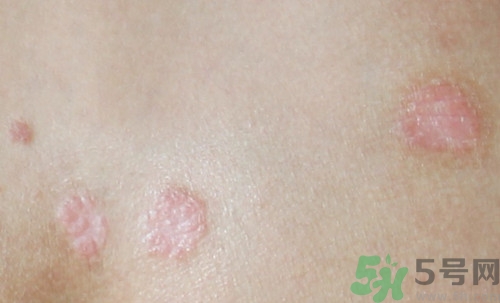 蕁麻疹能否根治?蕁麻疹該怎么治療 蕁麻疹能否根治?蕁麻疹該怎么治療