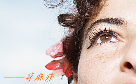 蕁麻疹中醫(yī)能治好嗎 蕁麻疹中醫(yī)調(diào)理需要多長時(shí)間好