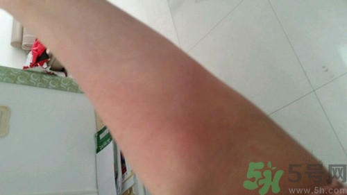 蕁麻疹是怎么引起的?蕁麻疹有什么癥狀 蕁麻疹是怎么引起的?蕁麻疹有什么癥狀