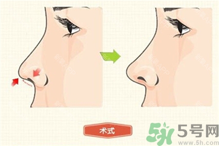 線雕隆鼻是什么?線雕隆鼻可以保持多久? 線雕隆鼻是什么?線雕隆鼻可以保持多久?