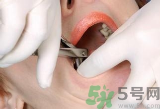 拔智齒能瘦臉嗎?拔智齒后注意事項 拔智齒能瘦臉嗎?拔智齒后注意事項