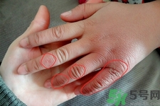 生凍瘡癢怎么辦？生凍瘡很癢的時(shí)候怎么辦？