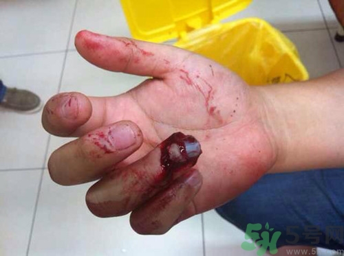 手被門夾了有淤血怎么辦?手被門夾了怎么緩解疼痛 手被門夾了有淤血怎么辦?手被門夾了怎么緩解疼痛