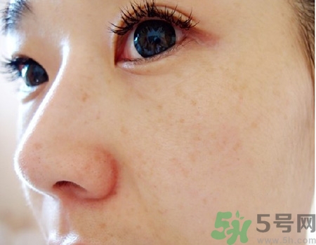 激光祛斑會反彈嗎?激光祛斑能維持多久? 激光祛斑會反彈嗎?激光祛斑能維持多久?