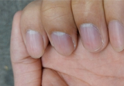 ?指甲上有豎紋是缺什么？指甲上有豎紋是缺維生素嗎？