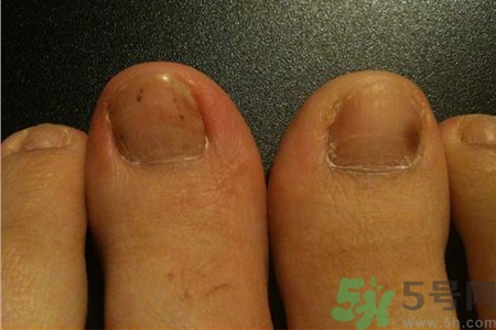 腳趾甲變黑是什么原因？腳趾甲變黑是怎么回事？