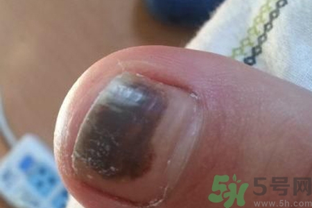 腳趾甲變黑是什么原因？腳趾甲變黑是怎么回事？