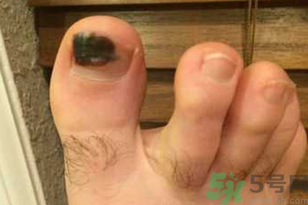 腳趾甲變黑是什么原因？腳趾甲變黑是怎么回事？
