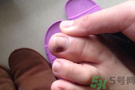 腳趾甲變黑是什么原因？腳趾甲變黑是怎么回事？