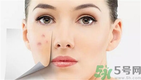 激光去痘印有效果嗎?激光祛痘會復發(fā)嗎?