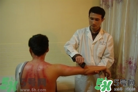 刮痧能治療風寒感冒嗎？刮痧治療風寒感冒效果好嗎