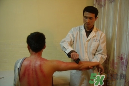 刮痧能去濕氣嗎？去濕氣是拔罐好還是刮痧好？