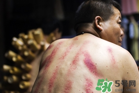 刮痧后什么顏色才健康？刮痧顏色反映的病癥