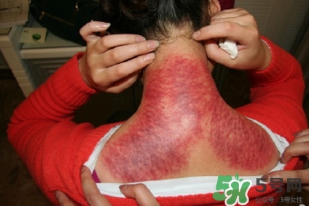 刮痧后什么顏色才健康？刮痧顏色反映的病癥