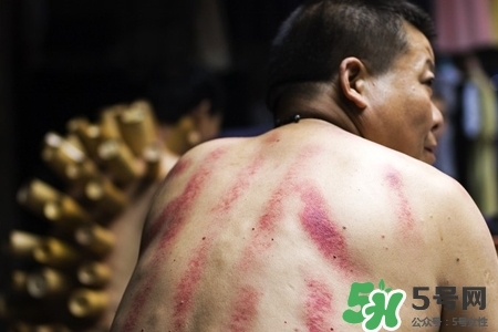 背部刮痧后能拔火罐嗎？背部刮痧后拔火罐有什么好處？