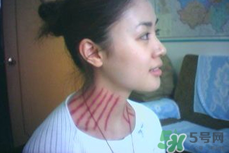 揪痧是什么？揪痧的好處有哪些？