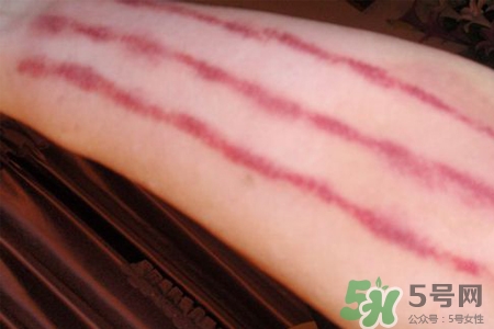 揪痧和刮痧哪個(gè)效果比較好？揪痧和刮痧的區(qū)別？