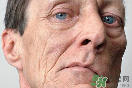 面癱能針灸嗎？針灸能治療面癱嗎？