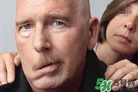 拔牙會導(dǎo)致面癱嗎?？拔牙為什么會導(dǎo)致面癱？