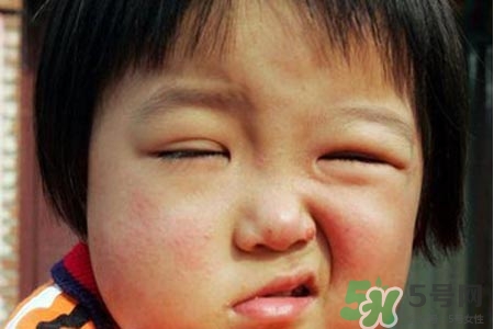 如何預(yù)防面癱復(fù)發(fā)？導(dǎo)致面癱的四大原因