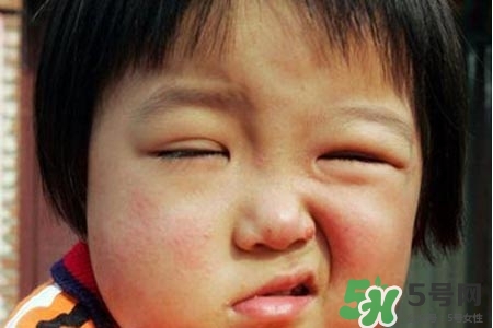 青少年面癱是怎么回事？青少年面癱是怎么辦？