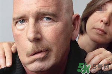 青少年面癱是怎么回事？青少年面癱是怎么辦？