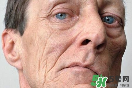 老年人為什么容易得面癱？老年人面癱原因有哪些？